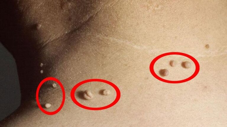 Questo semplice gesto ti libererà definitivamente dai fastidiosi fibromi…