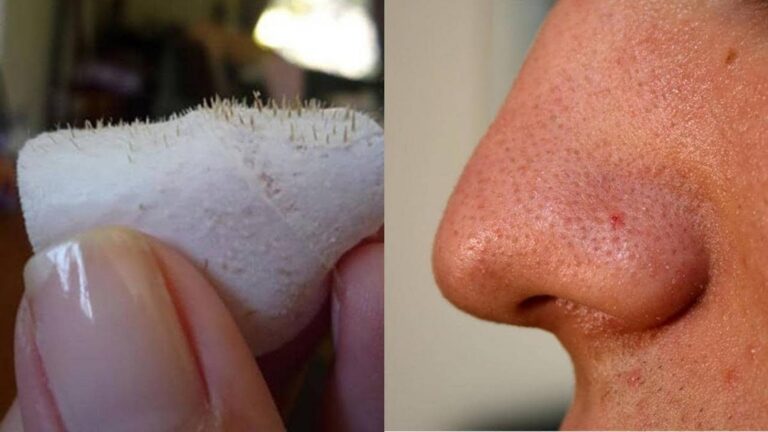 Un vecchio trucco per rimuovere i punti neri… scopri il segreto dei professionisti!