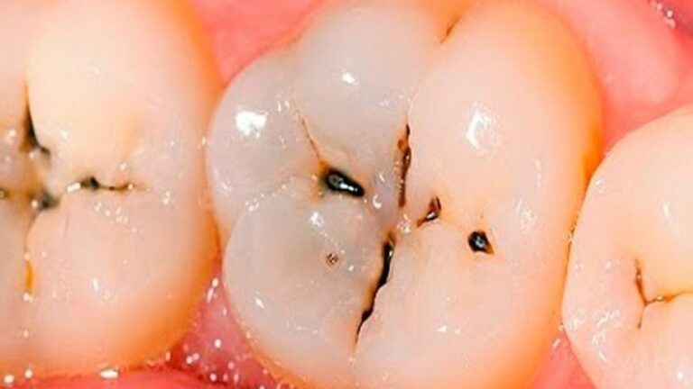 Questo semplice gesto trasformerà il tuo sorriso e combatterà la carie…